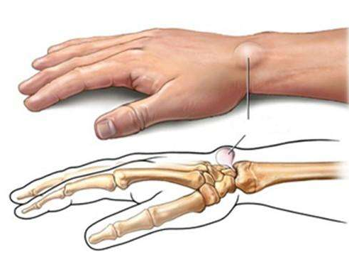 Kennen Sie Tenosynovitis?